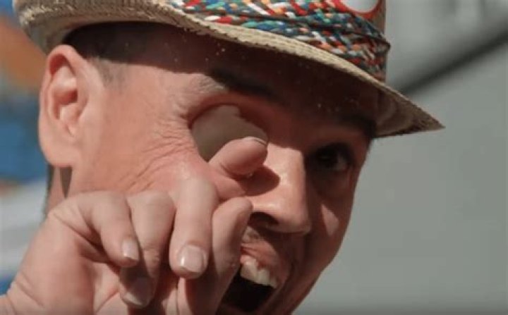 Billy Owen An Eye To Cancer And Then Reinvented Himself As A Zombie